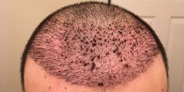 عوارض کاشت مو و راه های جلوگیری از آن